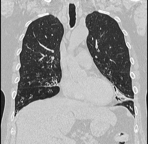 Alpha-1-antitrypsin deficiency (Radiopaedia 72058-82557 Coronal lung window 27).jpg