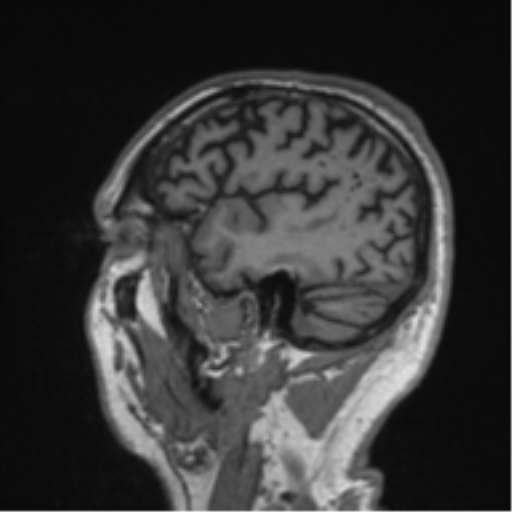 Alzheimer's disease- with Gerstmann syndrome and dressing apraxia (Radiopaedia 54882-61150 Sagittal T1 58).png