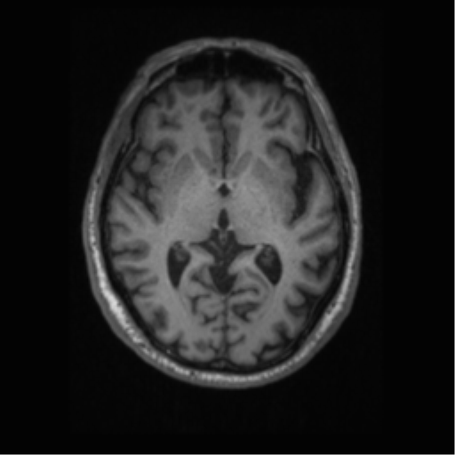 Alzheimer disease - probable (Radiopaedia 35334-36837 Axial T1 39).png