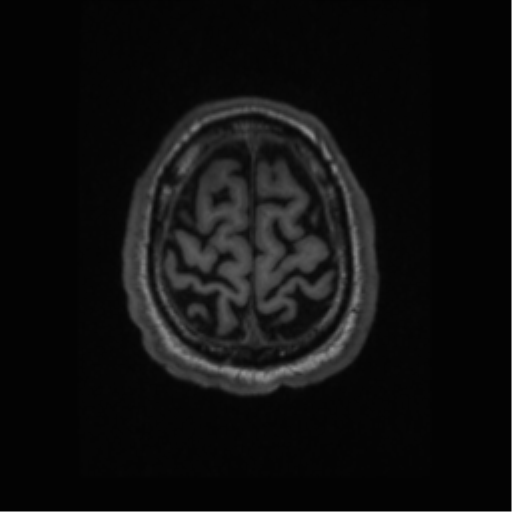 Alzheimer disease - probable (Radiopaedia 35334-36837 Axial T1 65).png