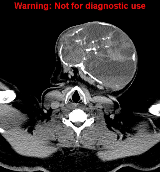 File:Ameloblastoma (Radiopaedia 33126-34164 B 26).jpg