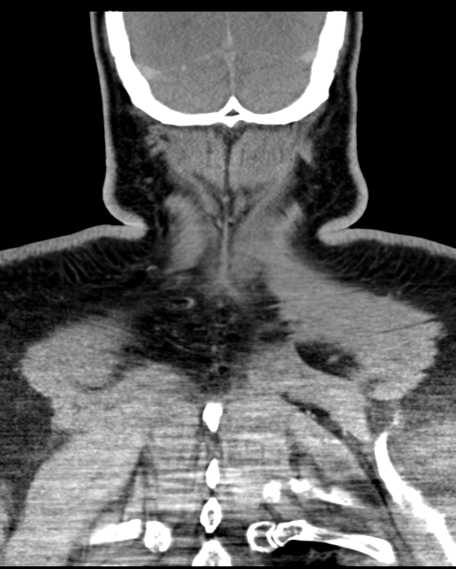 Ameloblastoma (Radiopaedia 38520-40623 Coronal non-contrast 69).png