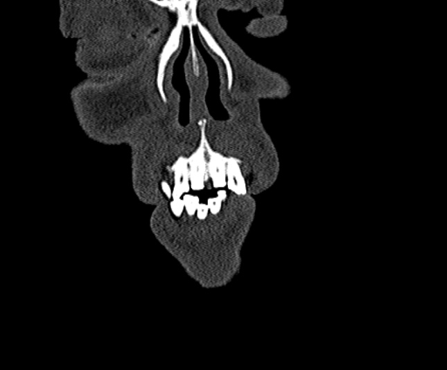 Ameloblastoma (Radiopaedia 51921-57766 Coronal bone window 10).jpg