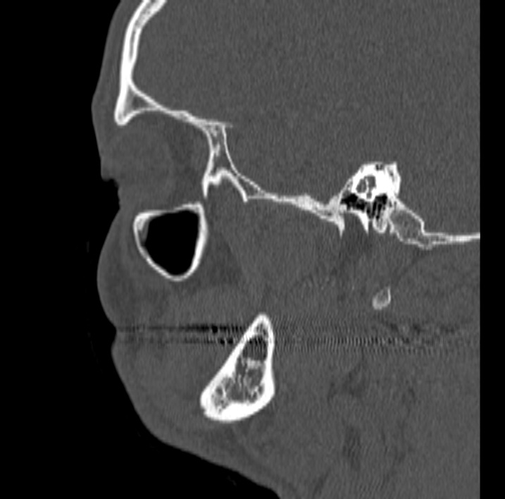 Ameloblastoma (Radiopaedia 77750-89997 Sagittal bone window 73).jpg