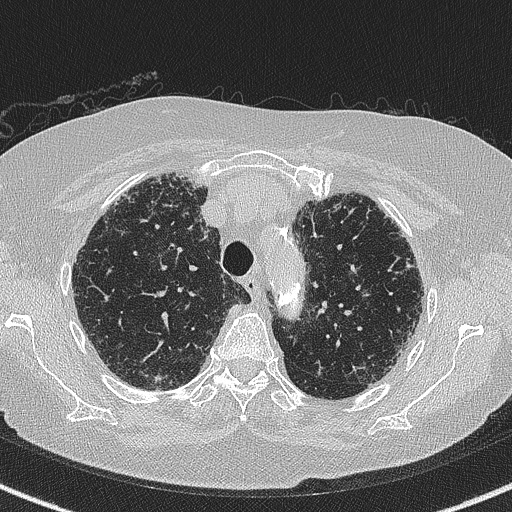 File:Amiodarone-induced pulmonary fibrosis (Radiopaedia 82355-96460 Axial lung window 18).jpg