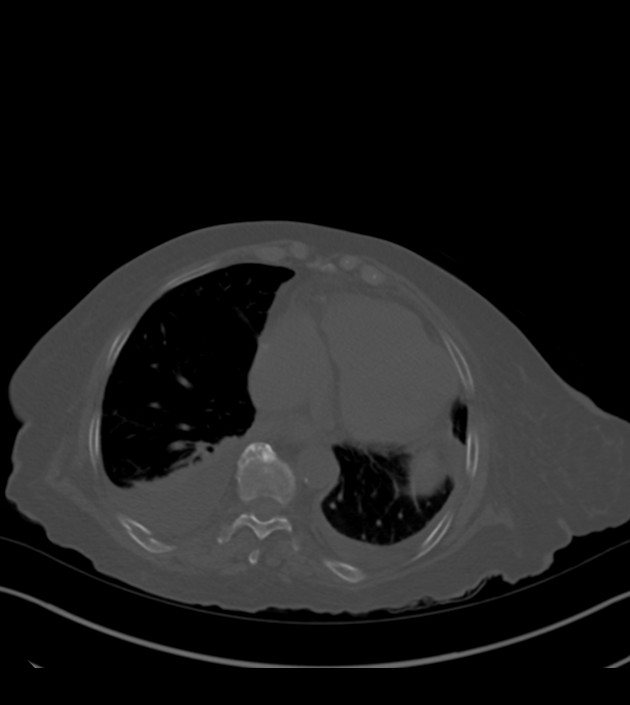 Amiodarone deposition in the liver (Radiopaedia 77587-89780 Axial bone window 61).jpg