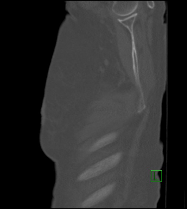 Amiodarone deposition in the liver (Radiopaedia 77587-89780 Sagittal bone window 89).jpg