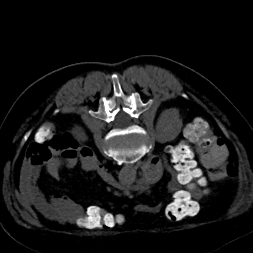 Ampullary adenocarcinoma (Radiopaedia 34013-35241 C 55).png