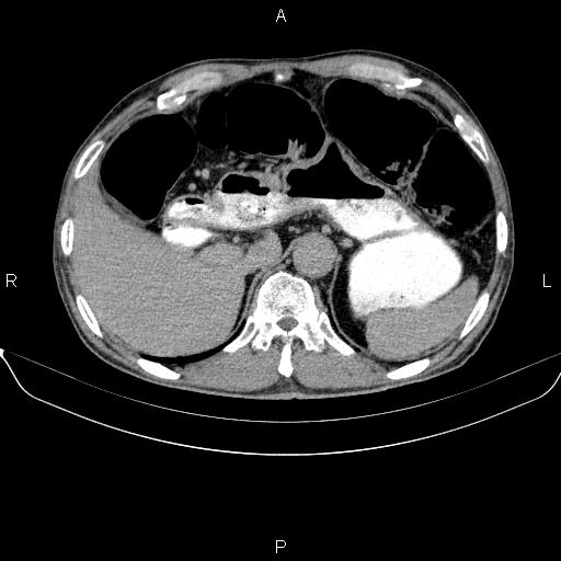 Ampullary adenocarcinoma (Radiopaedia 86093-102032 Axial C+ delayed 23).jpg