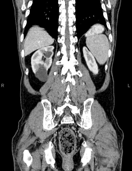 Ampullary adenocarcinoma (Radiopaedia 86093-102032 C 54).jpg