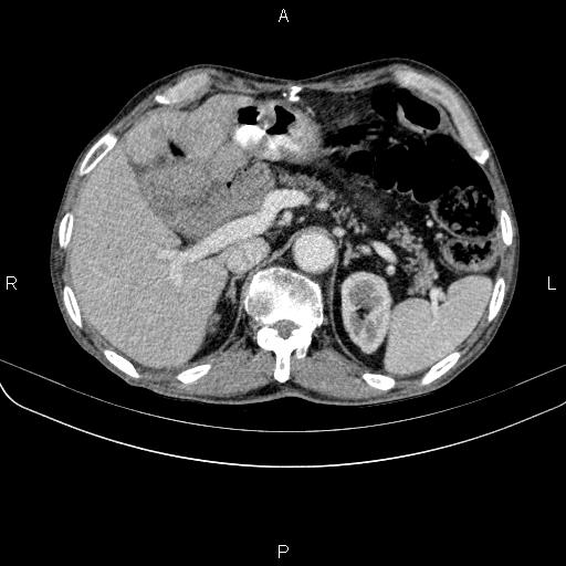 File:Ampullary adenocarcinoma (Radiopaedia 86093-102033 B 56).jpg