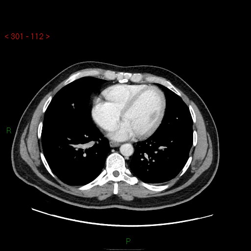 Ampullary carcinoma (Radiopaedia 56396-63056 C 2).jpg