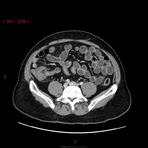 File:Ampullary carcinoma (Radiopaedia 56396-63056 C 67).jpg
