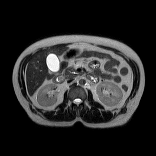 File:Ampullary tumor (Radiopaedia 27294-27479 T2 6).jpg