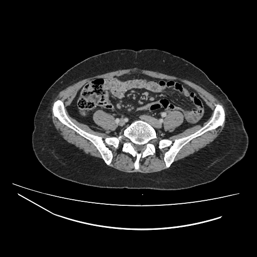 File:Ampullary tumor (Radiopaedia 60333-67998 A 62).jpg