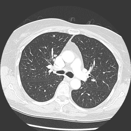 File:Amyloidosis - bronchial and diffuse nodular pulmonary involvement (Radiopaedia 60156-67745 Axial lung window 31).jpg