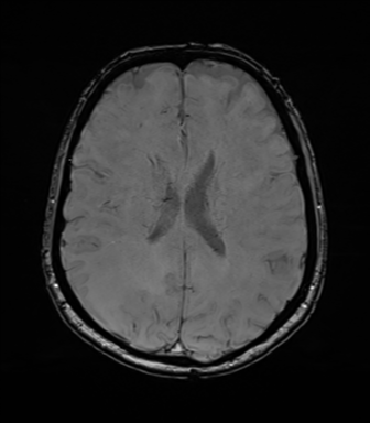 Anaplastic astrocytoma (Radiopaedia 86943-103160 Axial SWI 56).png