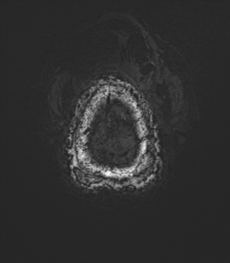 Anaplastic astrocytoma - thalamic glioma (Radiopaedia 59709-67115 G 88).png