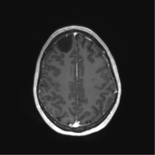 File:Anaplastic astrocytoma IDH mutant (Radiopaedia 50046-55341 Axial T1 C+ 37).png