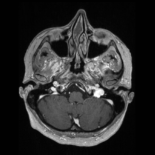 File:Anaplastic astrocytoma IDH wild-type (pseudoprogression) (Radiopaedia 42209-45276 Axial T1 C+ 32).png