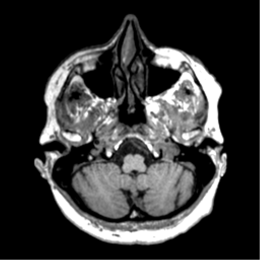 Anaplastic astrocytoma IDH wild-type (pseudoprogression) (Radiopaedia 42209-45277 Axial T1 21).png