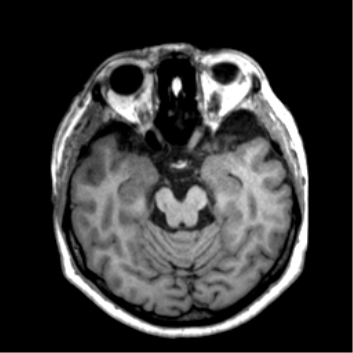 Anaplastic astrocytoma IDH wild-type (pseudoprogression) (Radiopaedia 42209-45277 Axial T1 49).png
