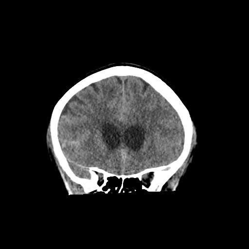 Aneursym related subarachnoid hemorrhage with hydrocephalus (Radiopaedia 45105-49083 Coronal non-contrast 20).jpg