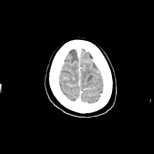 Aneursym related subarachnoid hemorrhage with hydrocephalus (Radiopaedia 45105-49084 D 49).jpg