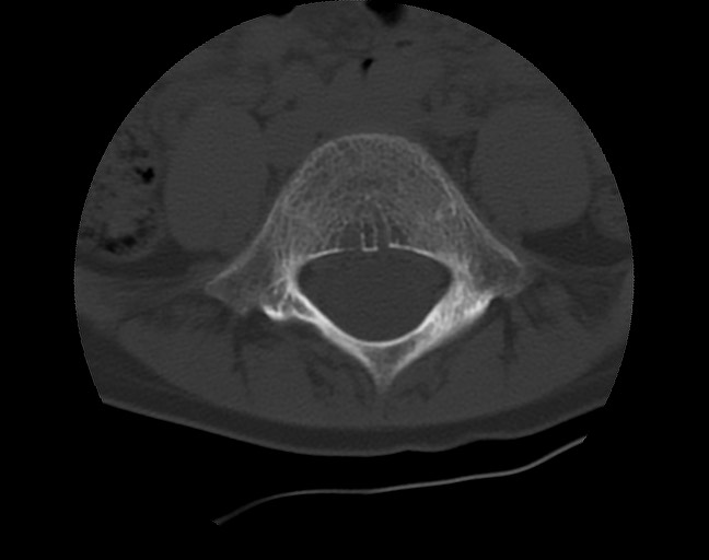 Aneurysmal bone cyst - sacrum (Radiopaedia 65190-74195 Axial bone window 9).jpg