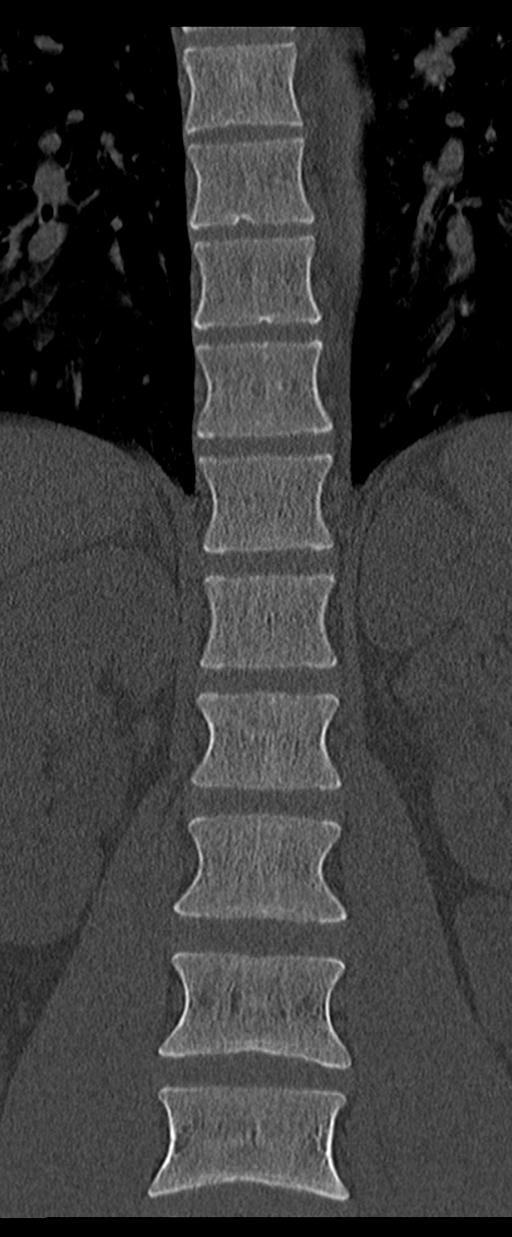 Aneurysmal bone cyst T11 (Radiopaedia 29294-29721 Coronal bone window 23).jpg