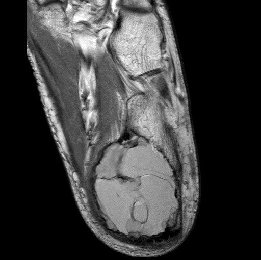 File:Aneurysmal bone cyst of the calcaneus (Radiopaedia 60669-68420 Axial PD 7).jpg