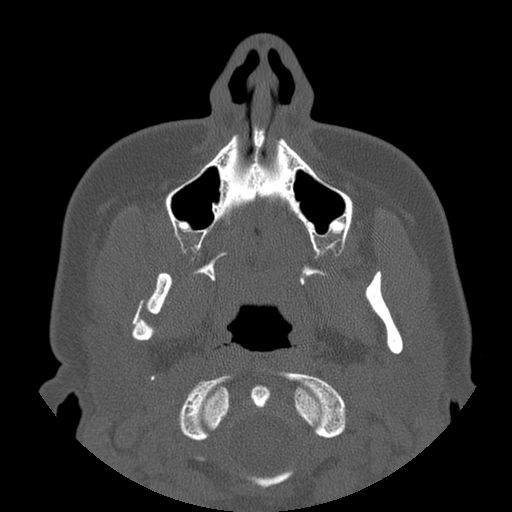 File:Aneurysmal bone cyst of the mandible (Radiopaedia 43280-46823 Axial bone window 102).jpg