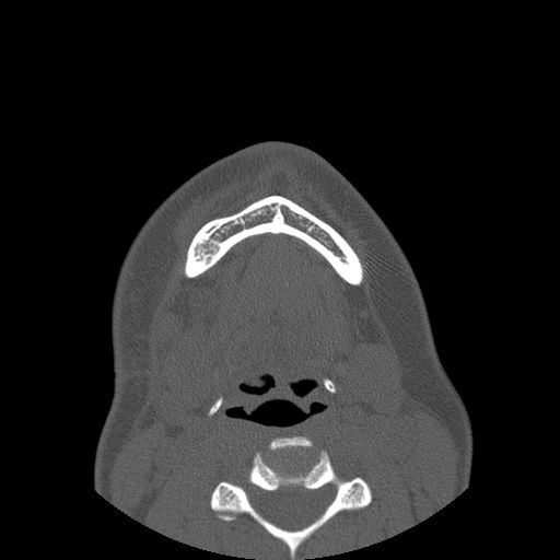 Aneurysmal bone cyst of the mandible (Radiopaedia 43280-46823 Axial bone window 19).jpg