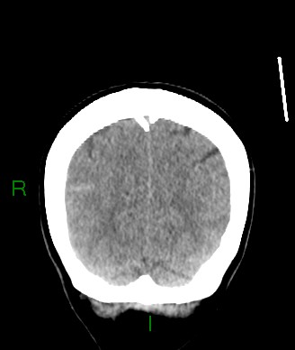 Aneurysmal subarachnoid hemorrhage with intra-axial extension (Radiopaedia 84371-99699 Coronal non-contrast 15).jpg