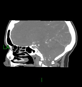 Aneurysmal subarachnoid hemorrhage with intra-axial extension (Radiopaedia 84371-99732 B 39).jpg
