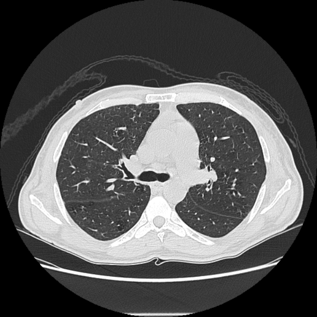 Angioinvasive aspergellosis (Radiopaedia 66995-76315 Axial lung window 20).jpg