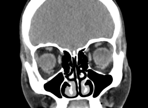 Angular dermoid cyst (Radiopaedia 88967-105790 Coronal non-contrast 26).jpg