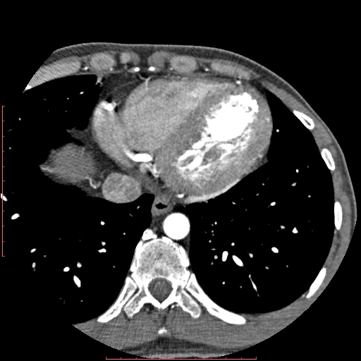 Anomalous left coronary artery from the pulmonary artery (ALCAPA) (Radiopaedia 70148-80181 A 301).jpg