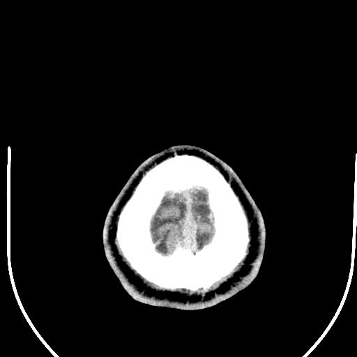 Anterior choroidal artery infarct (Radiopaedia 55106-61480 Axial non-contrast 63).jpg