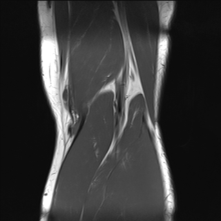 File:Anterior cruciate ligament full thickness tear (Radiopaedia 66268-75467 Coronal T1 19).jpg