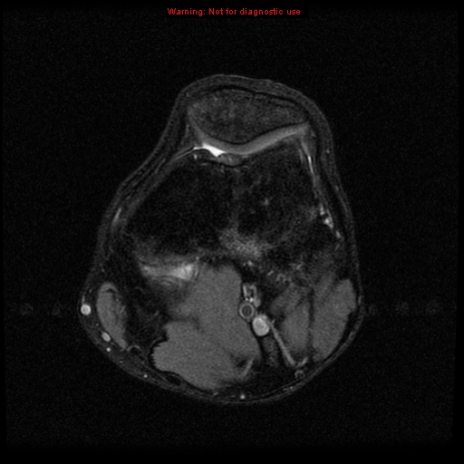 File:Anterior cruciate ligament injury - partial thickness tear (Radiopaedia 12176-12515 Axial PD 9).jpg