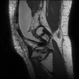 Anterior cruciate ligament rupture with Segond fracture (Radiopaedia 69043-78806 Sagittal PD 156).jpg