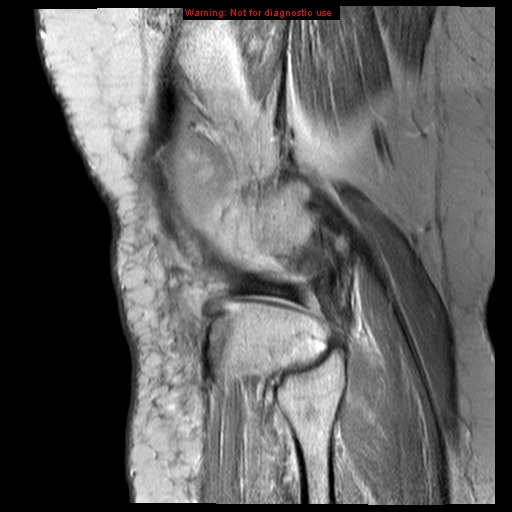 File:Anterior cruciate ligament tear (Radiopaedia 12329-12612 Sagittal T2 fat sat 3).jpg