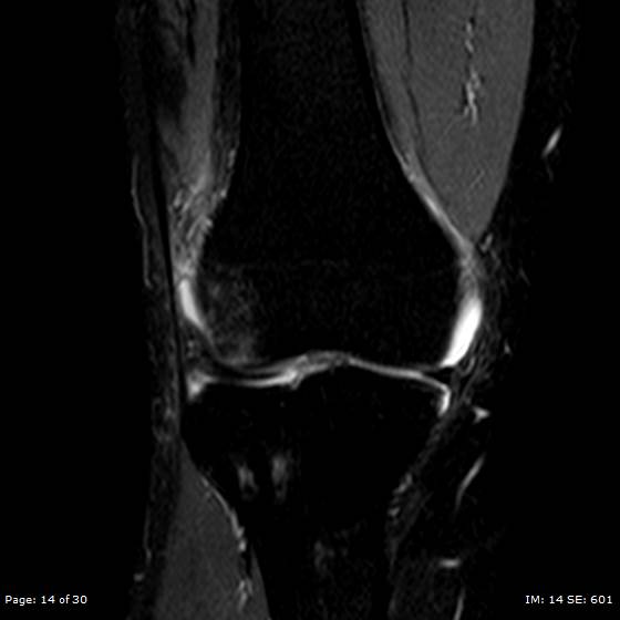 File:Anterior cruciate ligament tear (Radiopaedia 70783-80964 Coronal STIR 14).jpg
