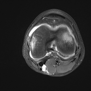 File:Anterior cruciate ligament tear - pediatric (Radiopaedia 62152-70260 Axial PD fat sat 21).jpg