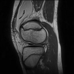 Anterior cruciate ligament tear - pediatric (Radiopaedia 62152-70260 Sagittal PD 130).jpg