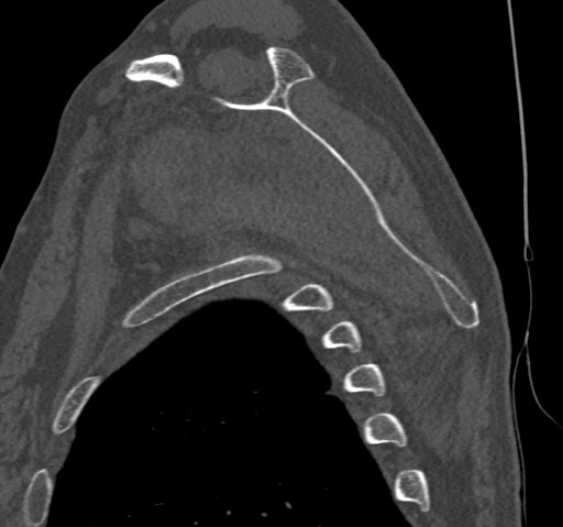 Anterior glenohumeral dislocation with Hill-Sachs lesion (Radiopaedia 62877-71249 Sagittal bone window 44).jpg