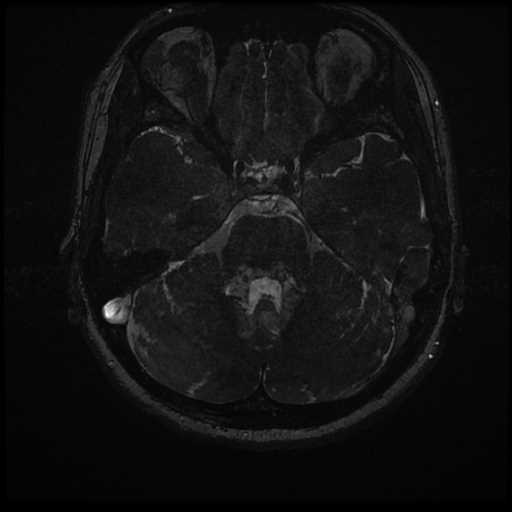 Anterior inferior cerebellar artery vascular loop - type II (Radiopaedia 70991-81209 Axial 3D FIESTA 9).jpg