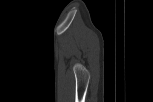 Anterior inferior iliac spine avulsion injury (Radiopaedia 88666-105376 Sagittal bone window 87).jpg