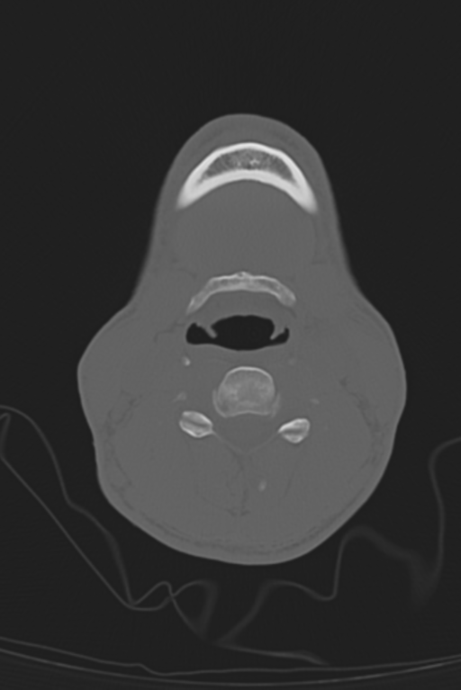 Anterior nasal spine fracture (Radiopaedia 46138-50494 Axial bone window 79).png